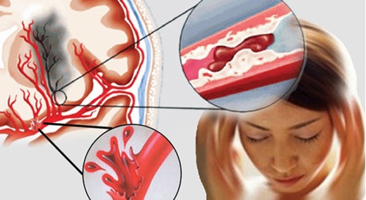 Cung cấp máu cho não không đủ Cung cấp máu cho não không đủ